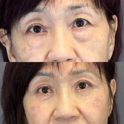 Asian Blepharoplasty Before & After Gallery - Patient 384279 - Image 1