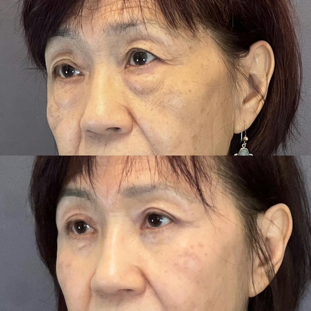 Asian Blepharoplasty Before & After Gallery - Patient 384279 - Image 3