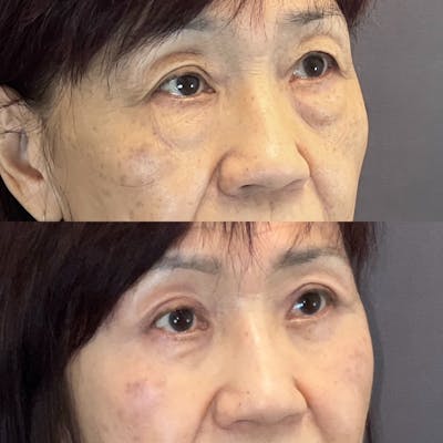 Asian Blepharoplasty Before & After Gallery - Patient 384279 - Image 2