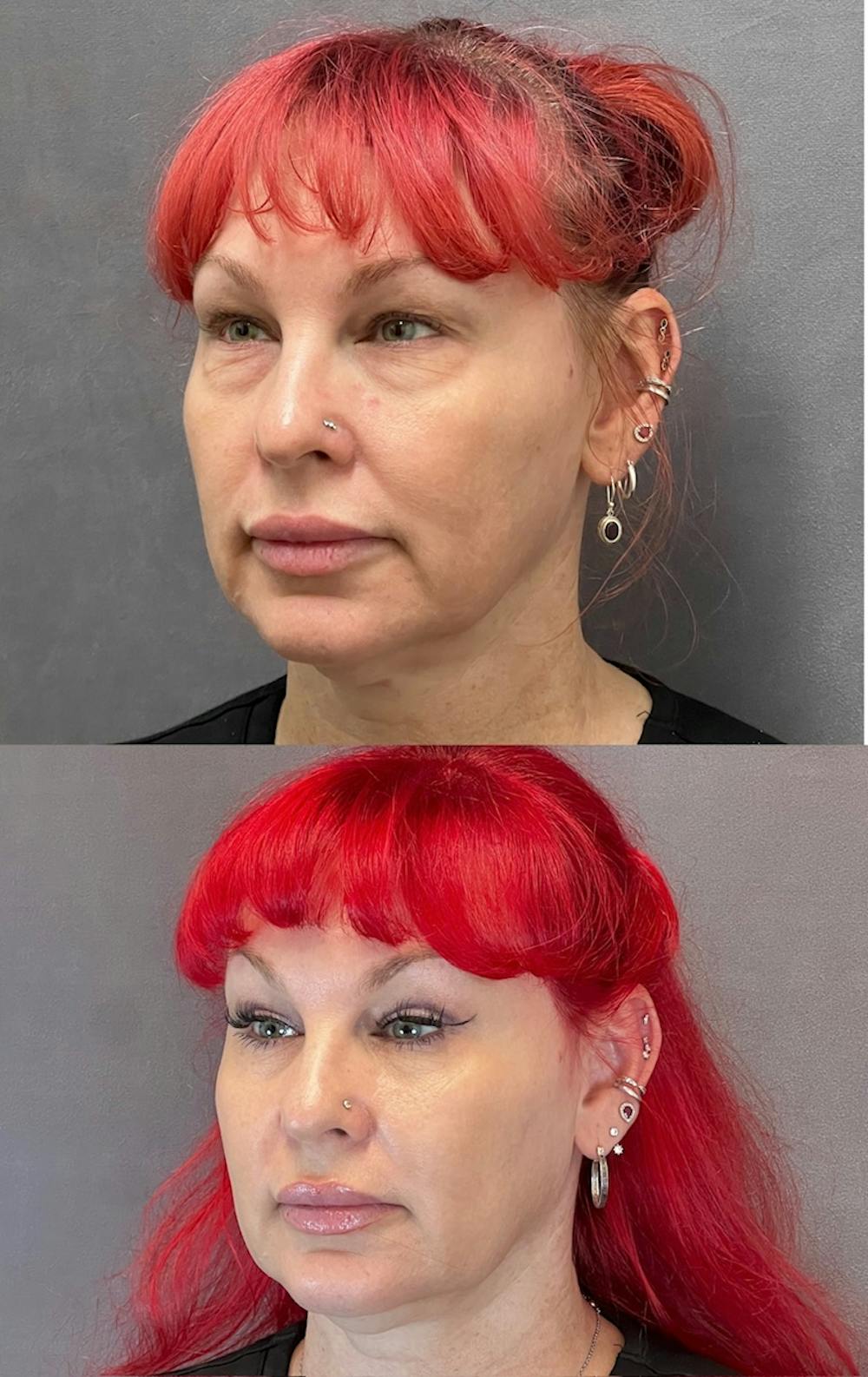 Lower Blepharoplasty Before & After Gallery - Patient 427266 - Image 4