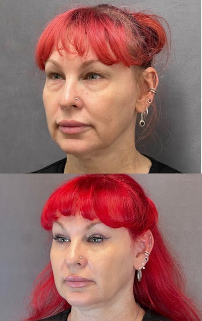 Lower Blepharoplasty Before & After Gallery - Patient 427266 - Image 4