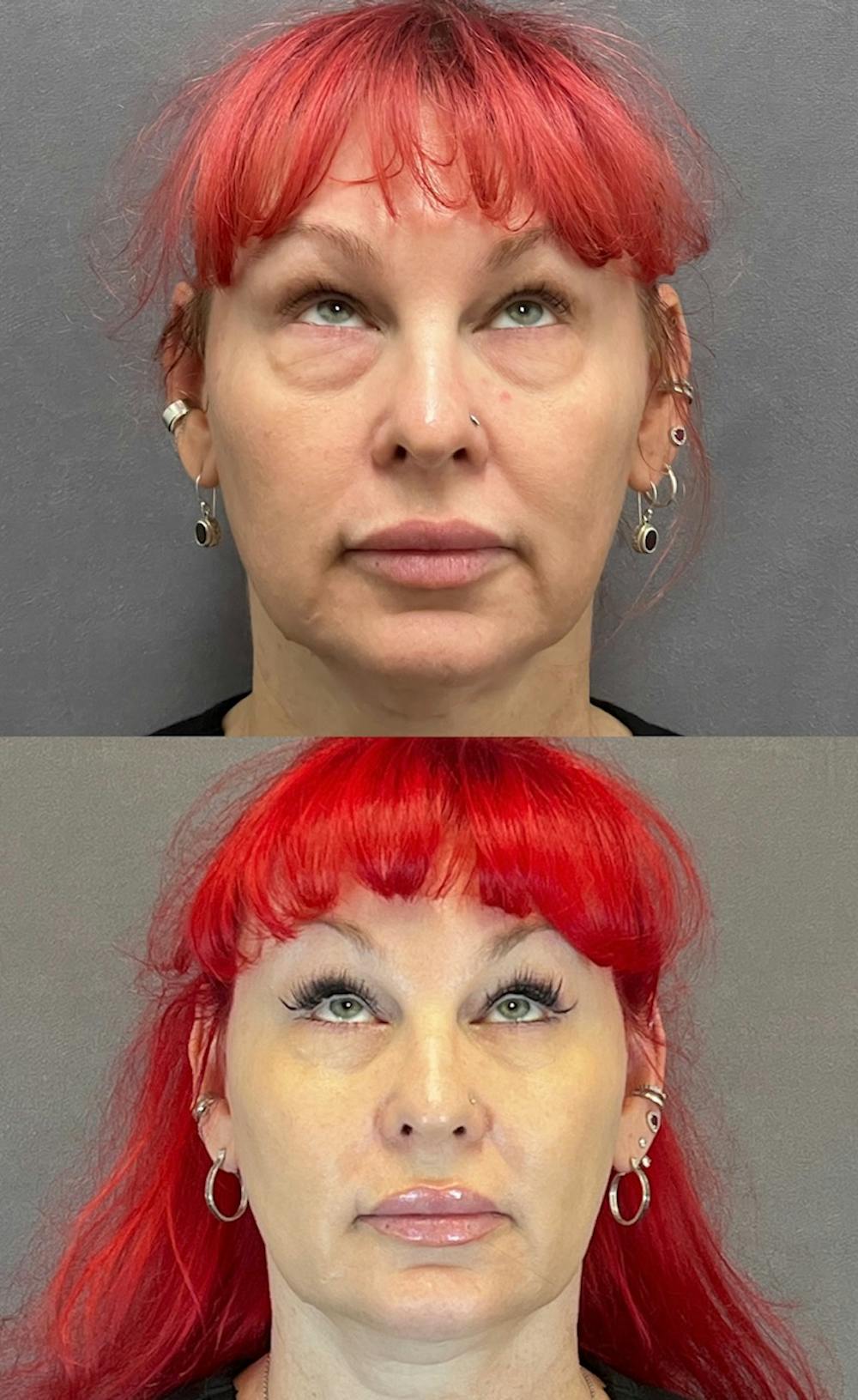 Lower Blepharoplasty Before & After Gallery - Patient 427266 - Image 2