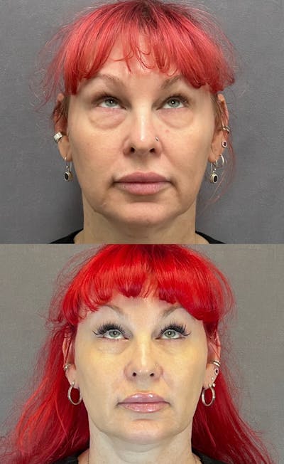 Lower Blepharoplasty Before & After Gallery - Patient 427266 - Image 2
