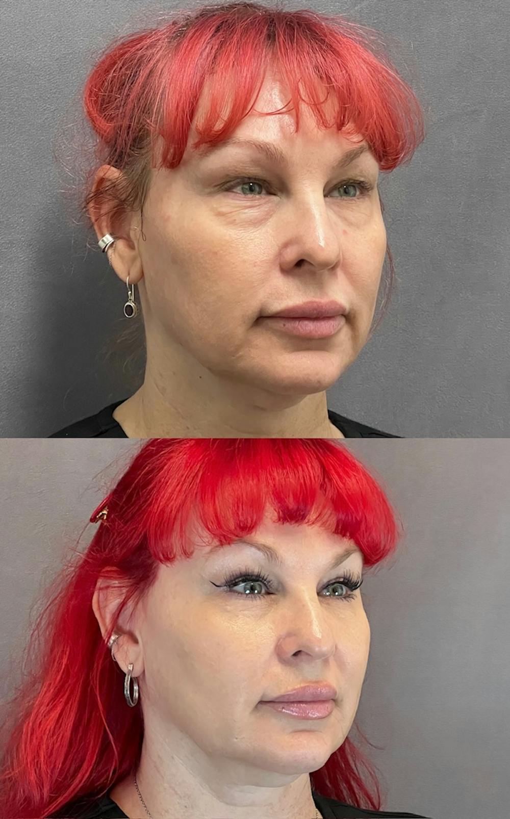 Lower Blepharoplasty Before & After Gallery - Patient 427266 - Image 3