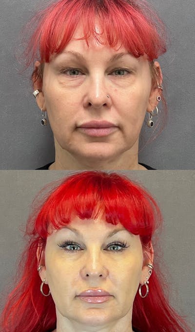 Lower Blepharoplasty Before & After Gallery - Patient 427266 - Image 1