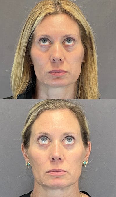 Lower Blepharoplasty Before & After Gallery - Patient 339581 - Image 2