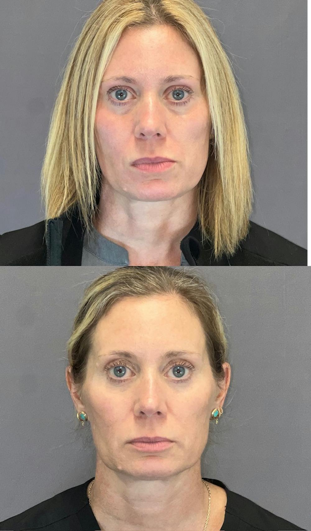 Lower Blepharoplasty Before & After Gallery - Patient 339581 - Image 1