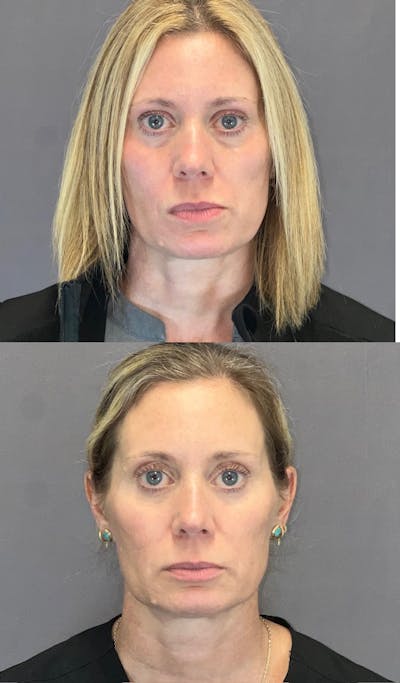 Lower Blepharoplasty Before & After Gallery - Patient 339581 - Image 1