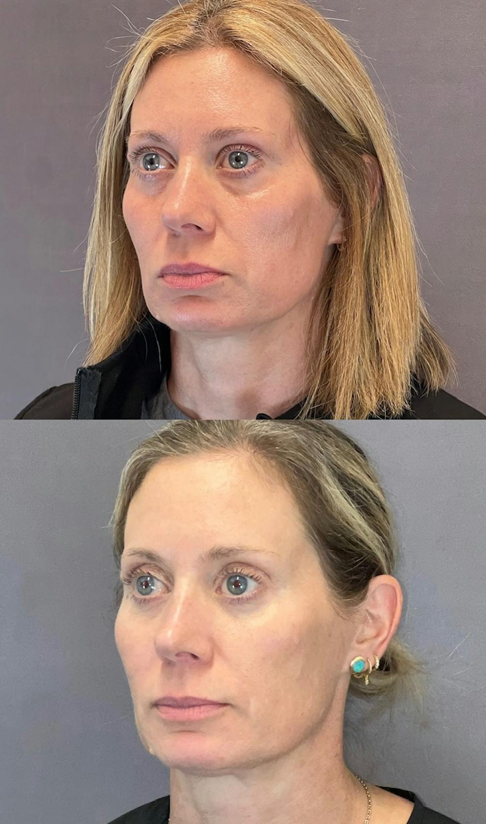 Lower Blepharoplasty Before & After Gallery - Patient 339581 - Image 4