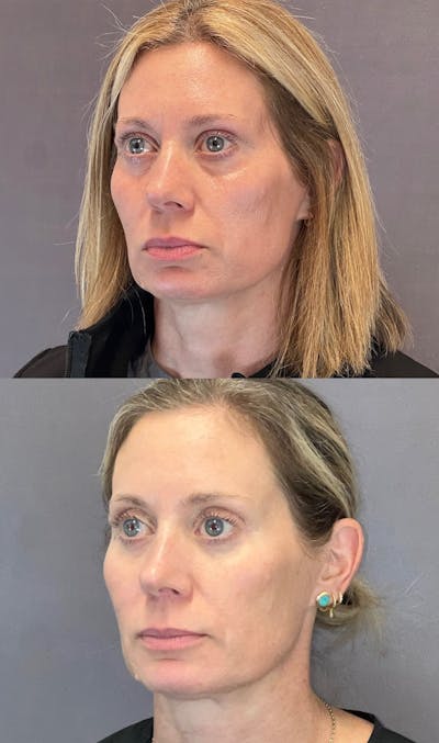 Lower Blepharoplasty Before & After Gallery - Patient 339581 - Image 4
