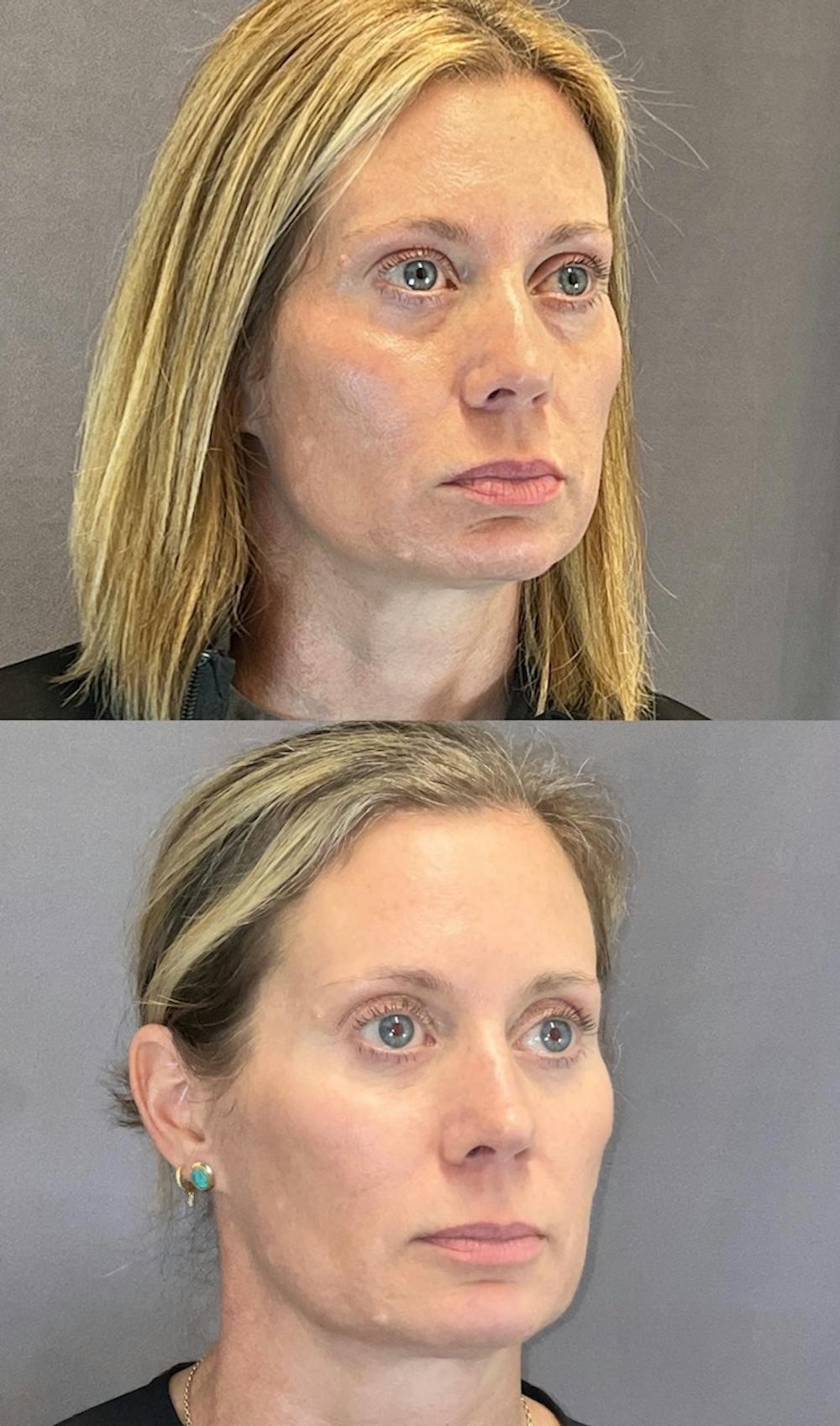 Lower Blepharoplasty Before & After Gallery - Patient 339581 - Image 3