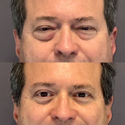 Lower Blepharoplasty Before & After Gallery - Patient 717823 - Image 1