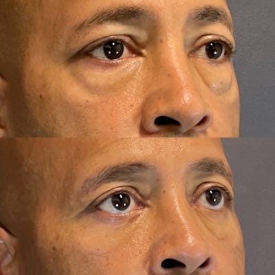 Lower Blepharoplasty Before & After Gallery - Patient 801077 - Image 2