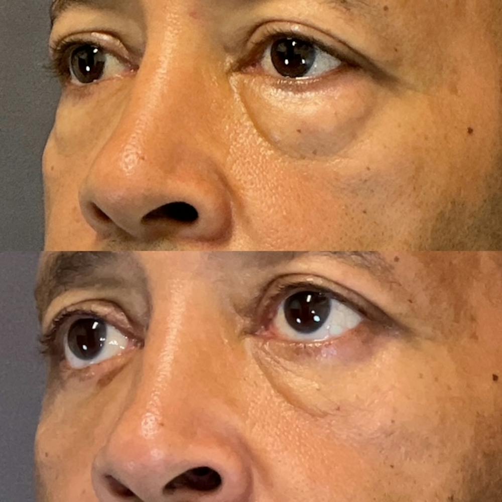 Lower Blepharoplasty Before & After Gallery - Patient 801077 - Image 3