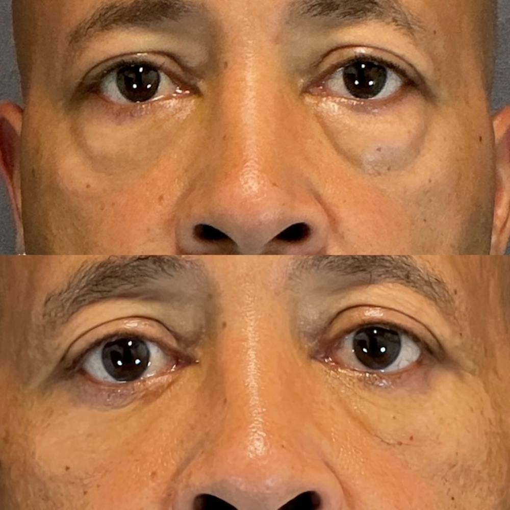 Lower Blepharoplasty Before & After Gallery - Patient 801077 - Image 1