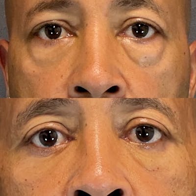 Lower Blepharoplasty Before & After Gallery - Patient 801077 - Image 1