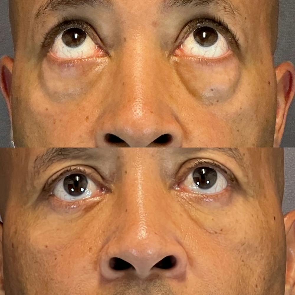 Lower Blepharoplasty Before & After Gallery - Patient 801077 - Image 4