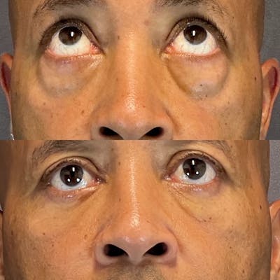Lower Blepharoplasty Before & After Gallery - Patient 801077 - Image 4