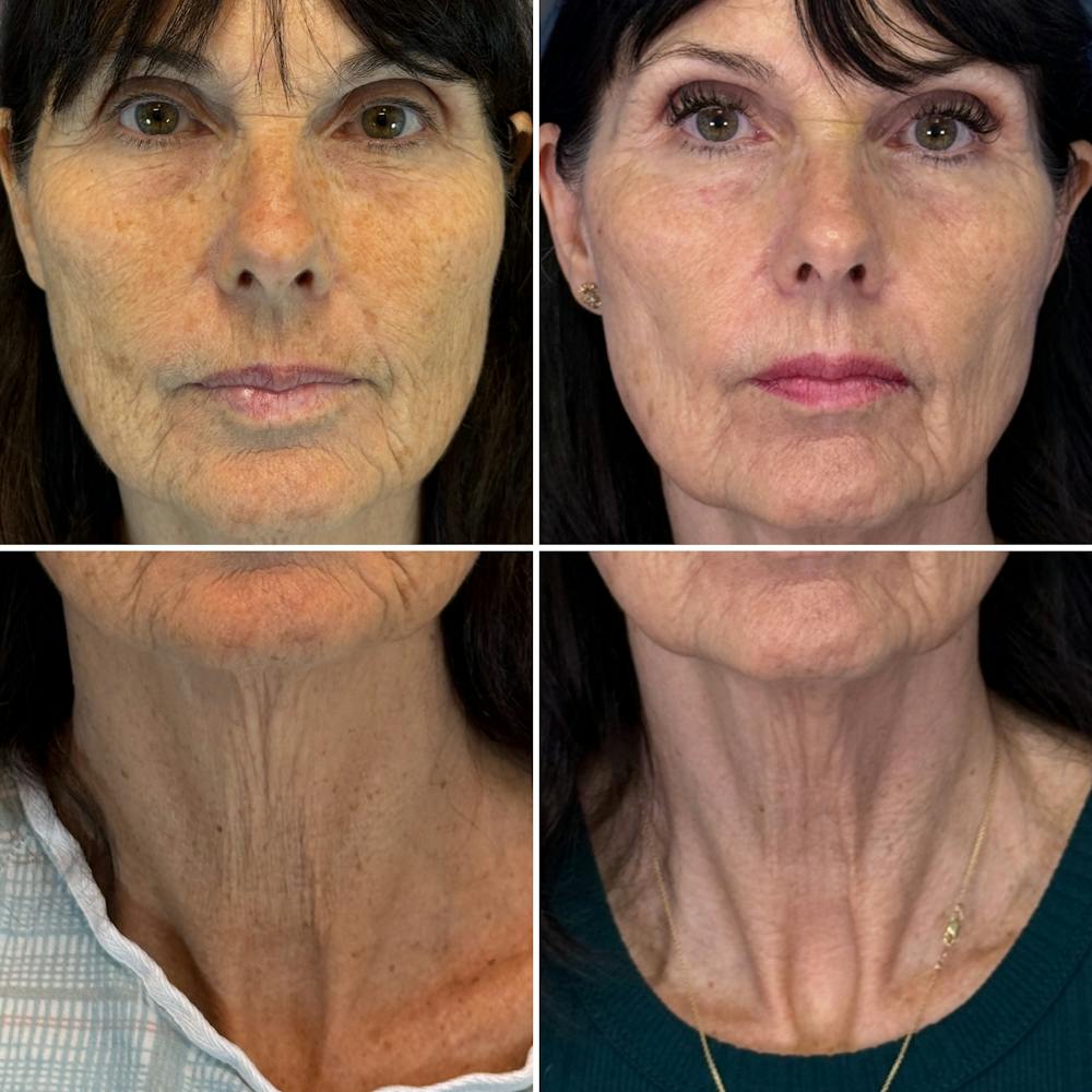 BBL Hero Before & After Gallery - Patient 912067 - Image 1