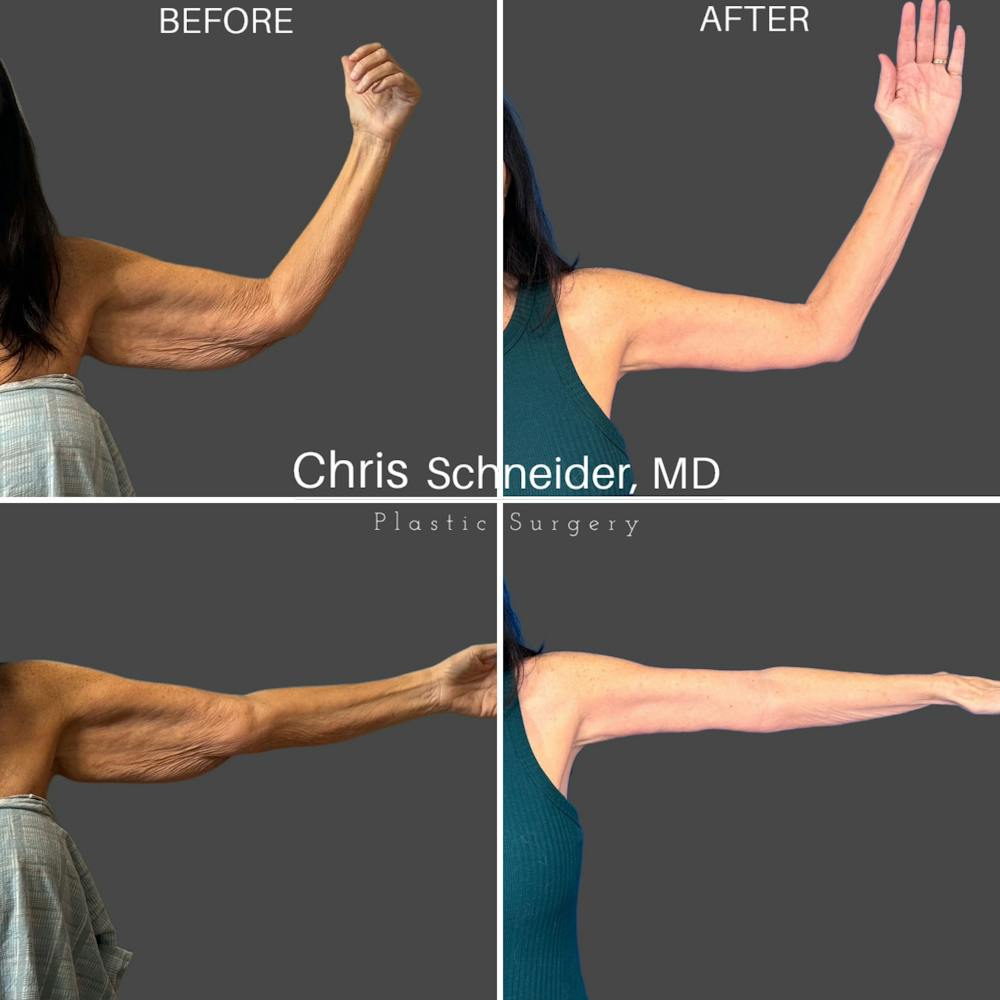 Arm Lift Before & After Gallery - Patient 761696 - Image 2