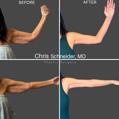 Arm Lift Before & After Gallery - Patient 761696 - Image 2
