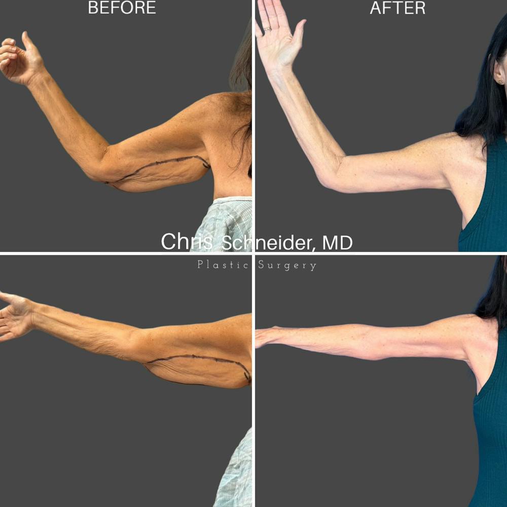 Arm Lift Before & After Gallery - Patient 761696 - Image 1