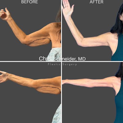 Arm Lift Before & After Gallery - Patient 761696 - Image 1
