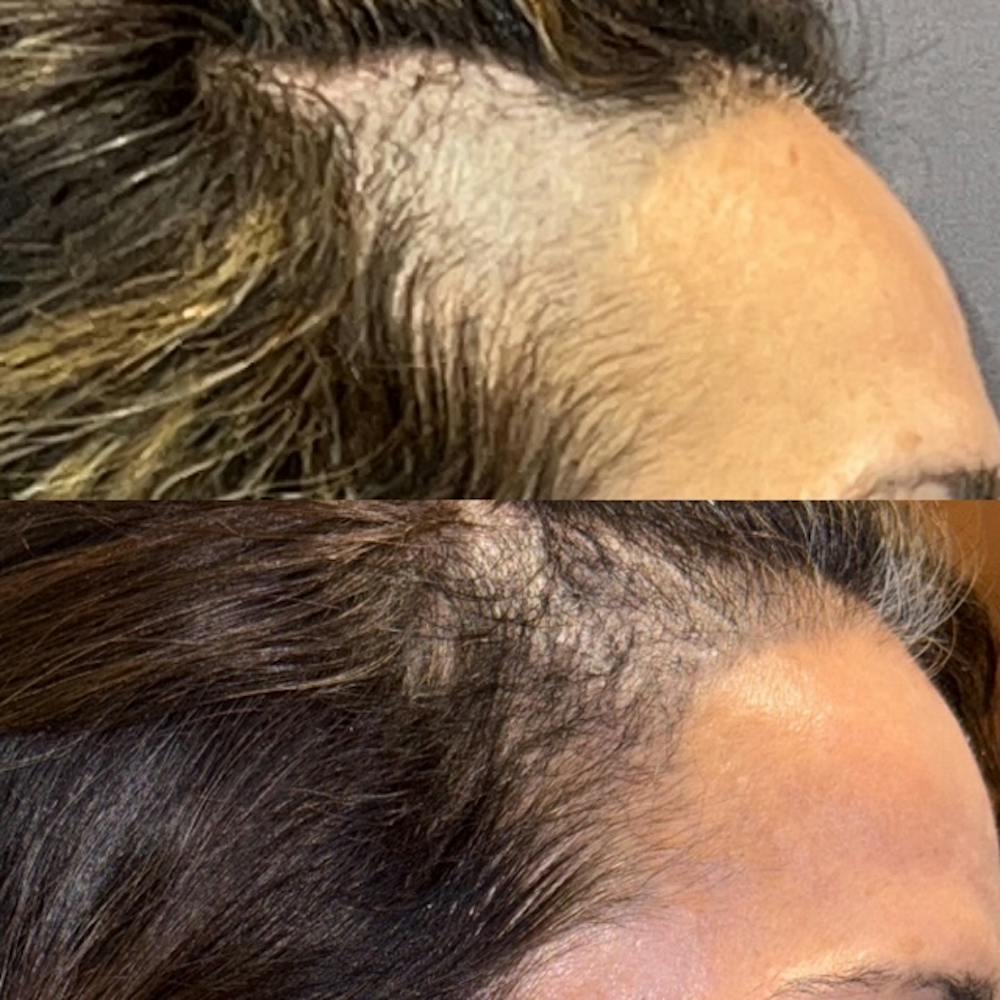 Hair Restoration  Before & After Gallery - Patient 322401 - Image 1