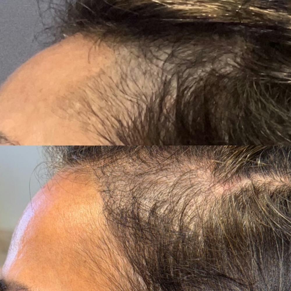 Hair Restoration  Before & After Gallery - Patient 322401 - Image 2