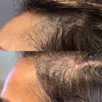 Hair Restoration  Before & After Gallery - Patient 322401 - Image 2