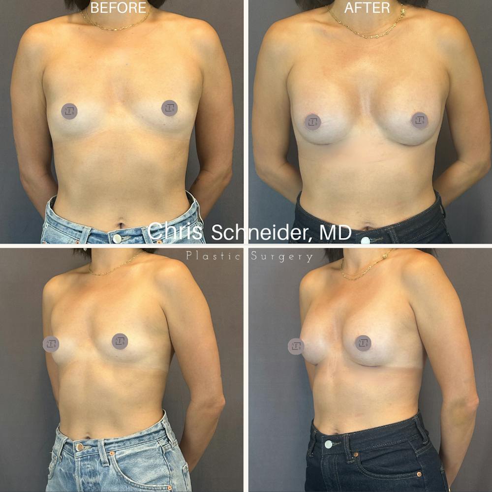 Breast Augmentation Before & After Gallery - Patient 748581 - Image 1