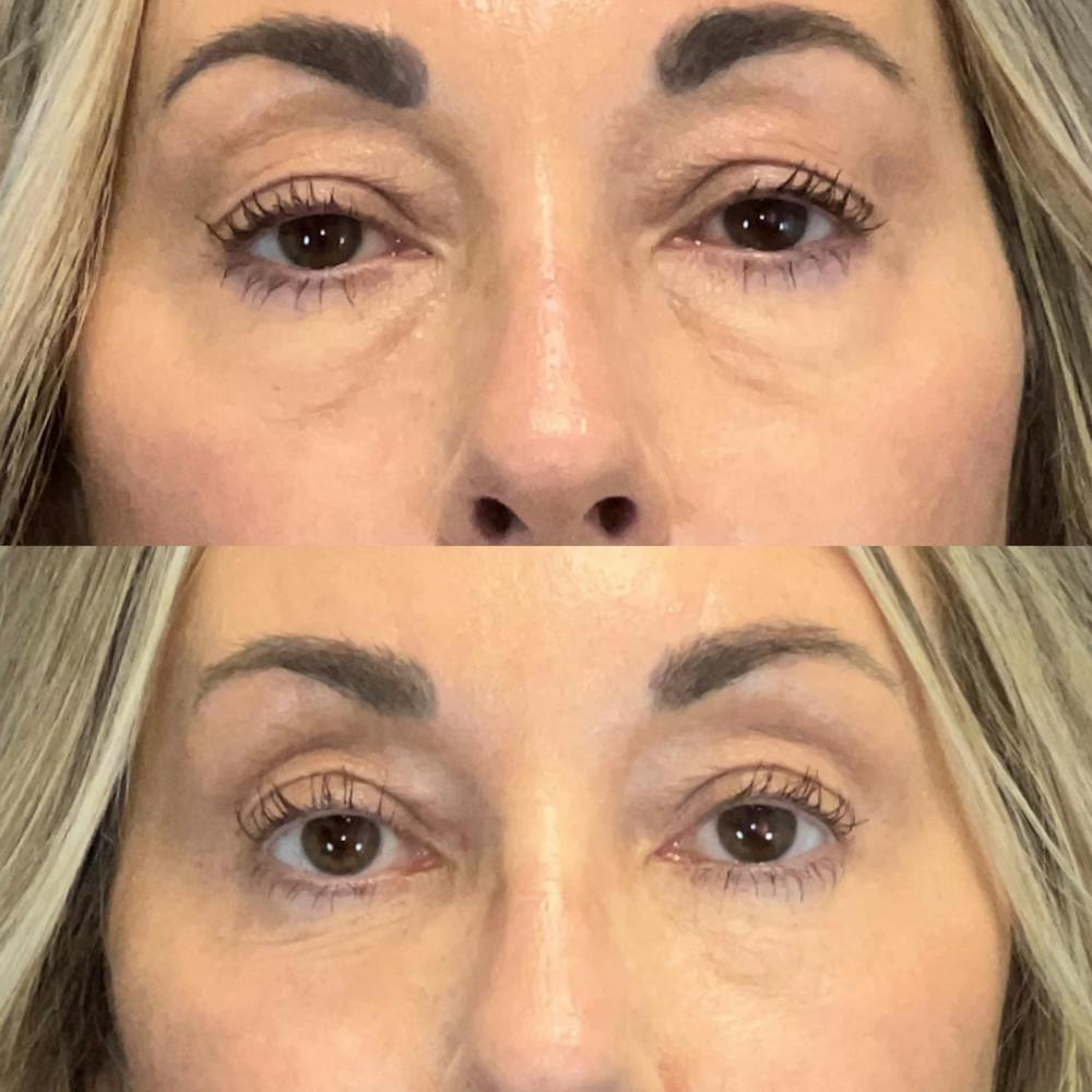 Lower Blepharoplasty Before & After Gallery - Patient 144239 - Image 1