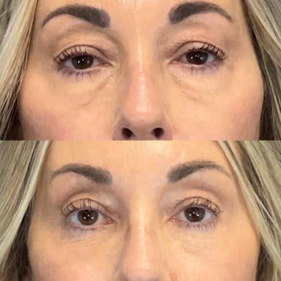 Lower Blepharoplasty Before & After Gallery - Patient 144239 - Image 1