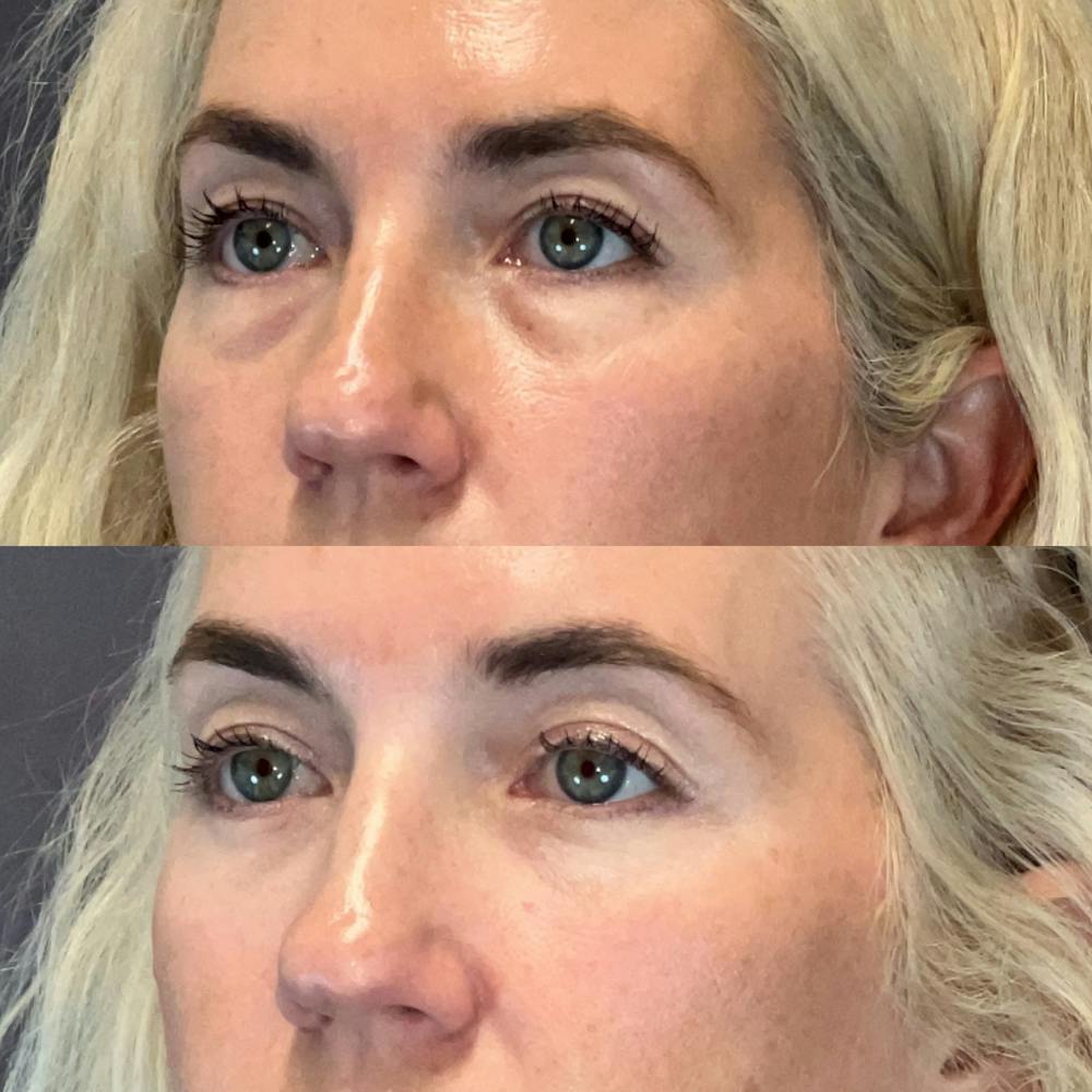 Lower Blepharoplasty Before & After Gallery - Patient 184476 - Image 3