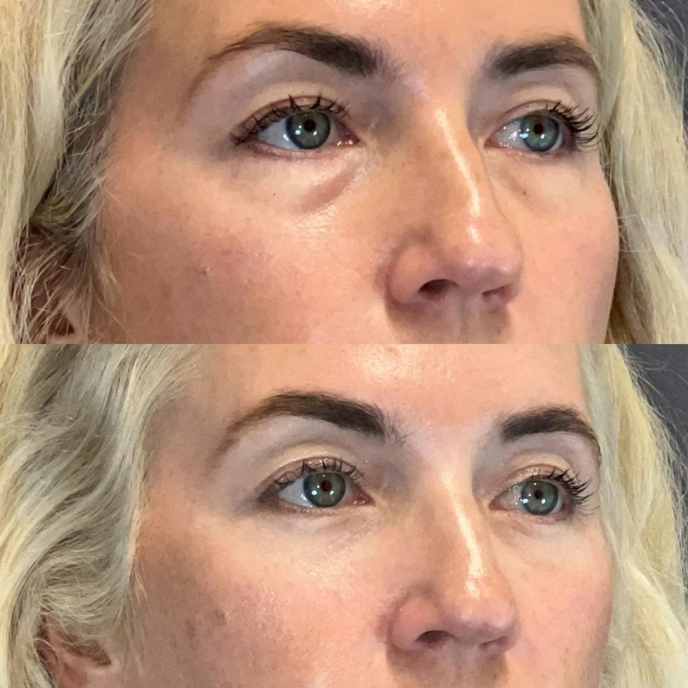 Lower Blepharoplasty Before & After Gallery - Patient 184476 - Image 2
