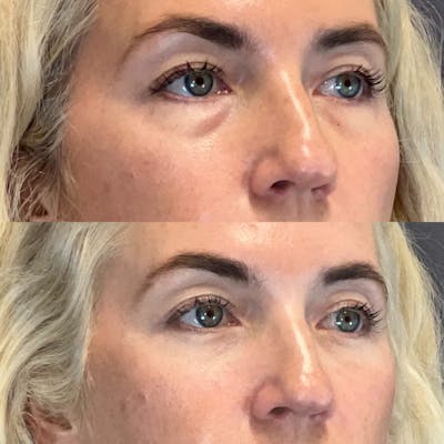 Lower Blepharoplasty Before & After Gallery - Patient 184476 - Image 2