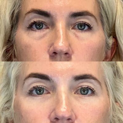 Lower Blepharoplasty Before & After Gallery - Patient 184476 - Image 1