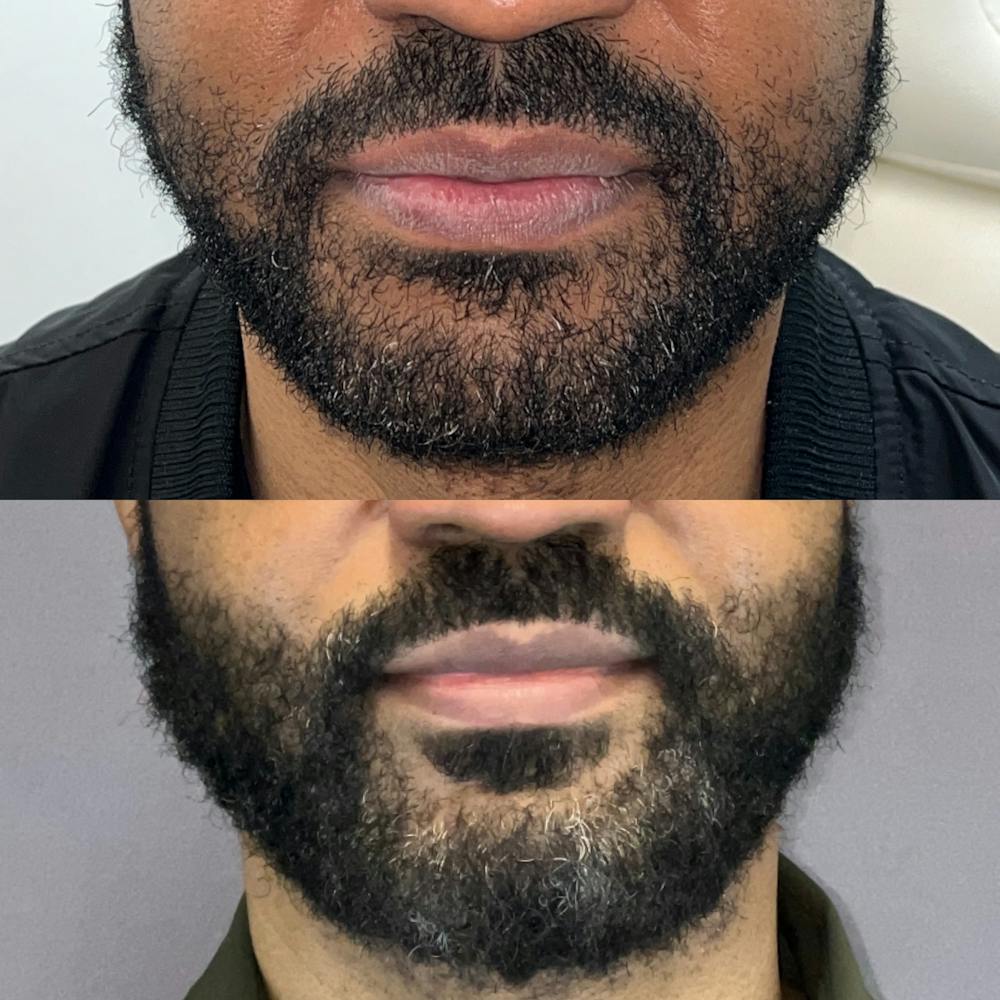 Hair Restoration  Before & After Gallery - Patient 885849 - Image 1