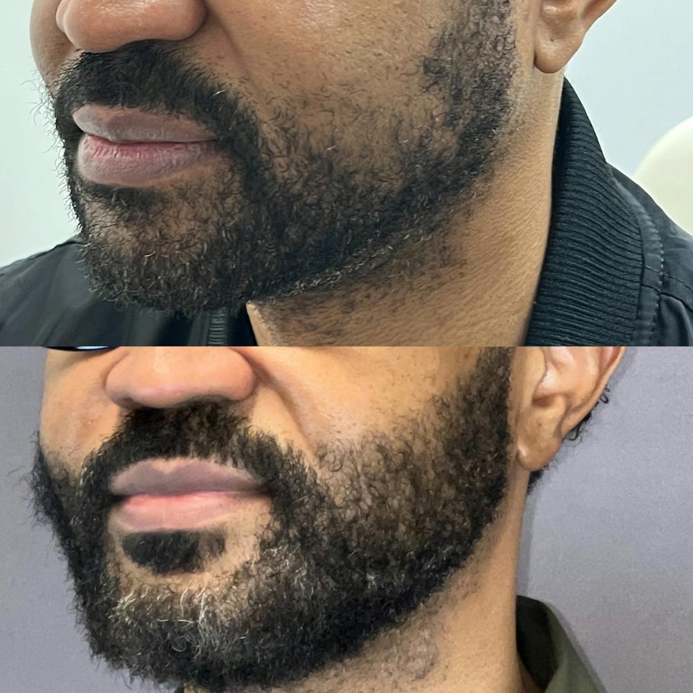 Hair Restoration  Before & After Gallery - Patient 885849 - Image 2