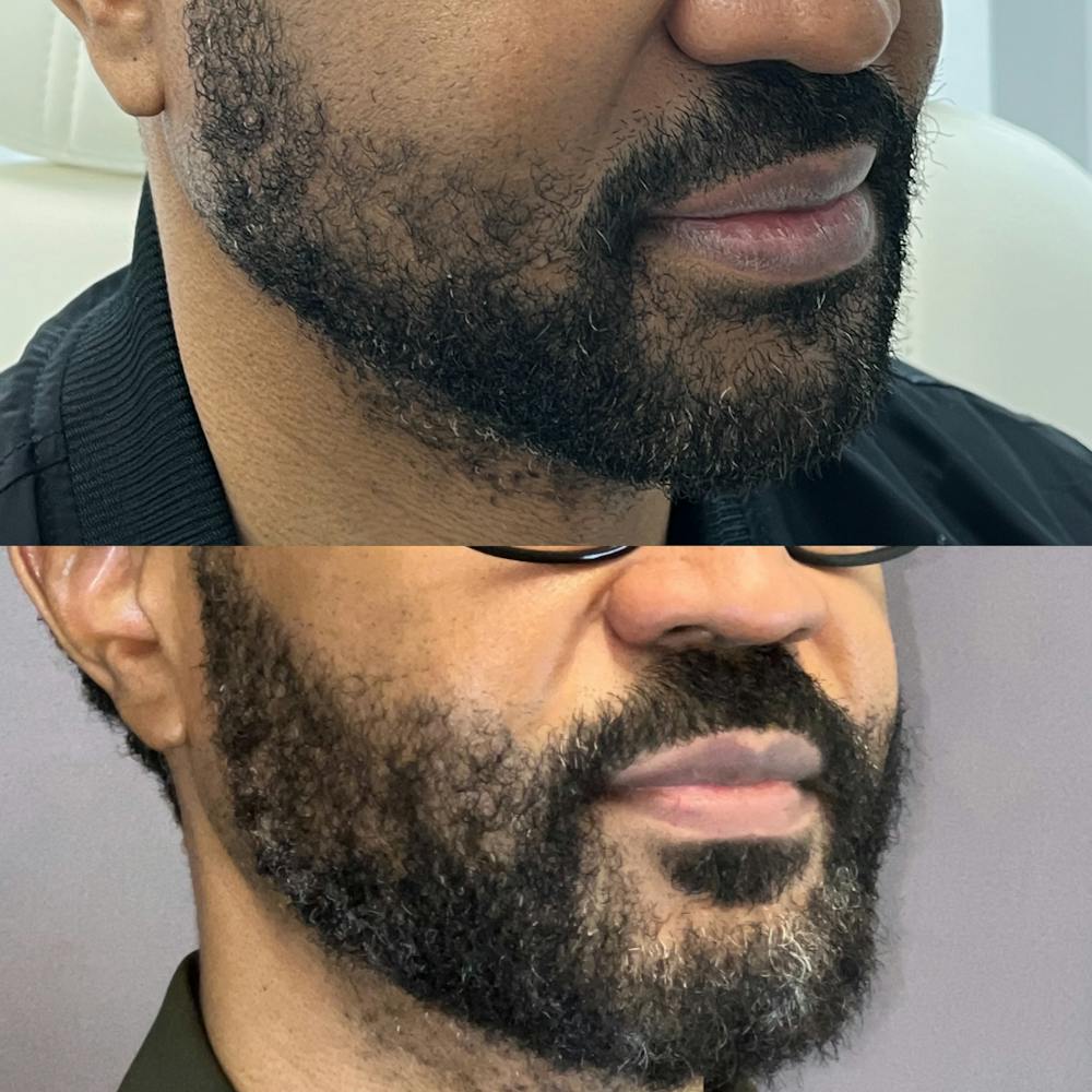 Hair Restoration  Before & After Gallery - Patient 885849 - Image 3