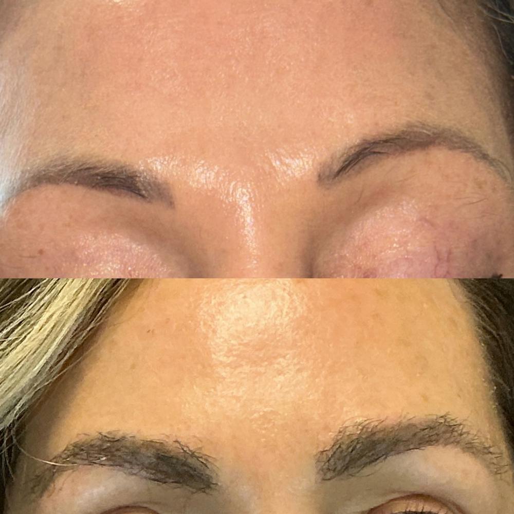 Eyebrow Transplant Before & After Gallery - Patient 139820 - Image 1