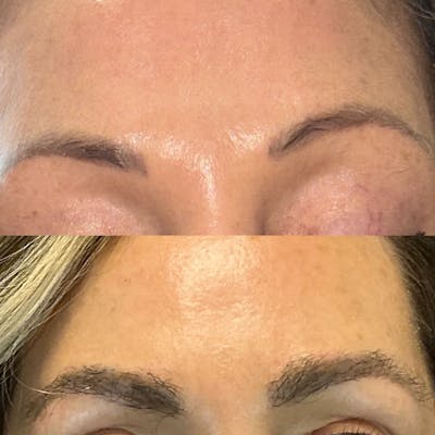 Eyebrow Transplant Before & After Gallery - Patient 139820 - Image 1