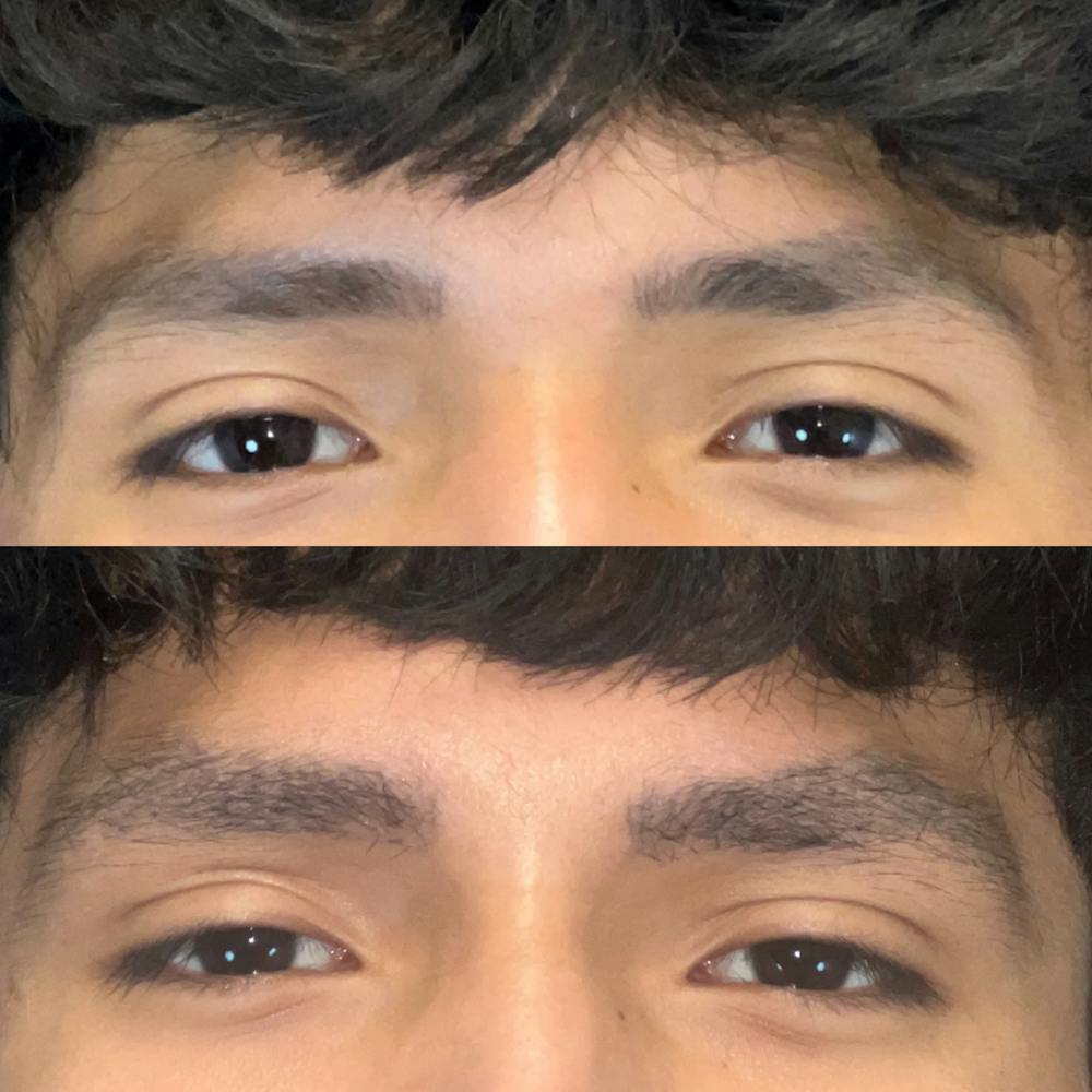 Eyebrow Transplant Before & After Gallery - Patient 520814 - Image 1