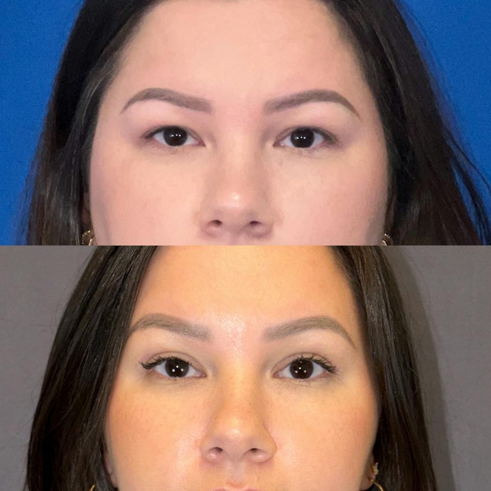 Brow Lift Before & After Gallery - Patient 331784 - Image 1