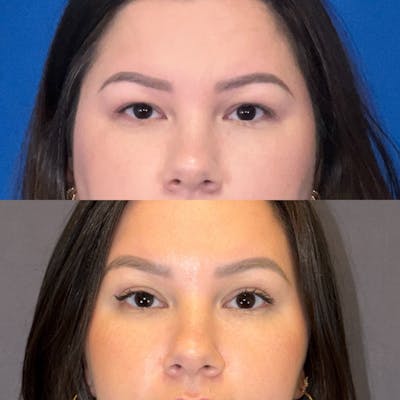 Brow Lift Before & After Gallery - Patient 331784 - Image 1