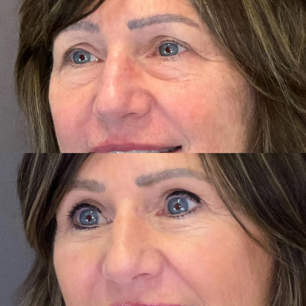 Brow Lift Before & After Gallery - Patient 343257 - Image 2