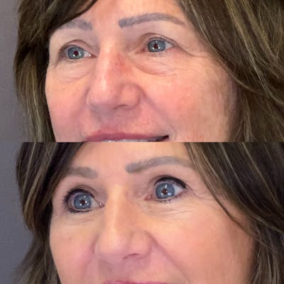Brow Lift Before & After Gallery - Patient 343257 - Image 2