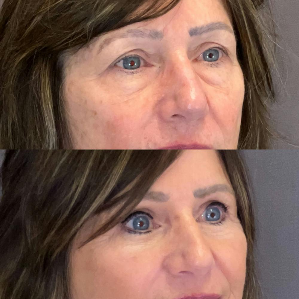 Brow Lift Before & After Gallery - Patient 343257 - Image 3