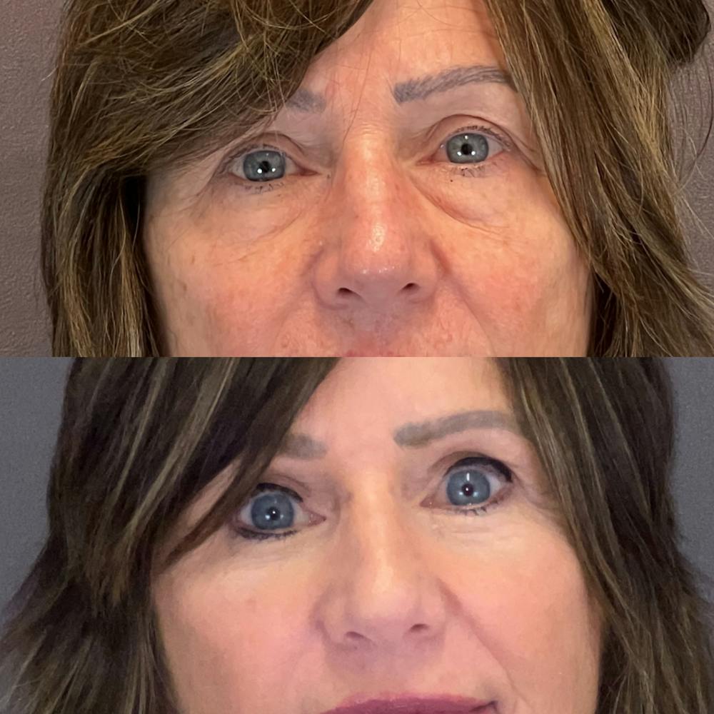 Brow Lift Before & After Gallery - Patient 343257 - Image 1