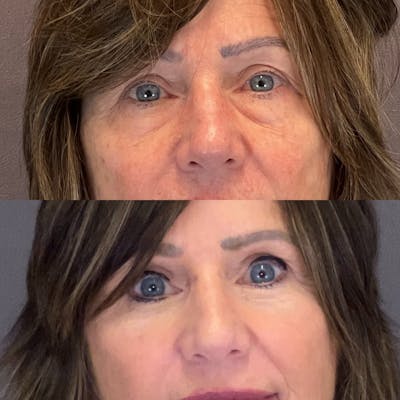 Brow Lift Before & After Gallery - Patient 343257 - Image 1